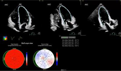 Cardiac dysfunctions in children with drug-resistant epilepsy